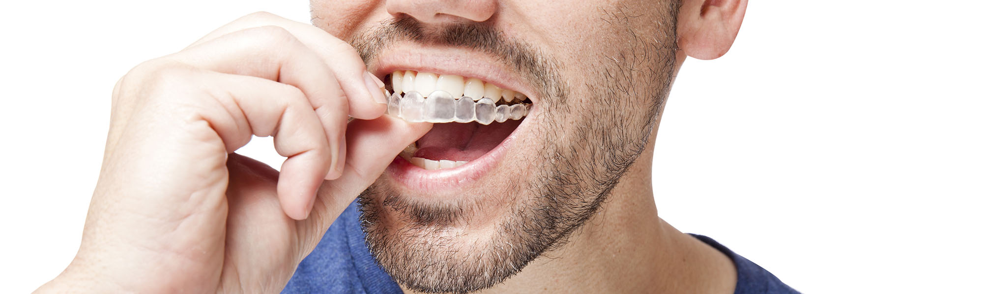 Can clear aligners fix teeth bite issues?